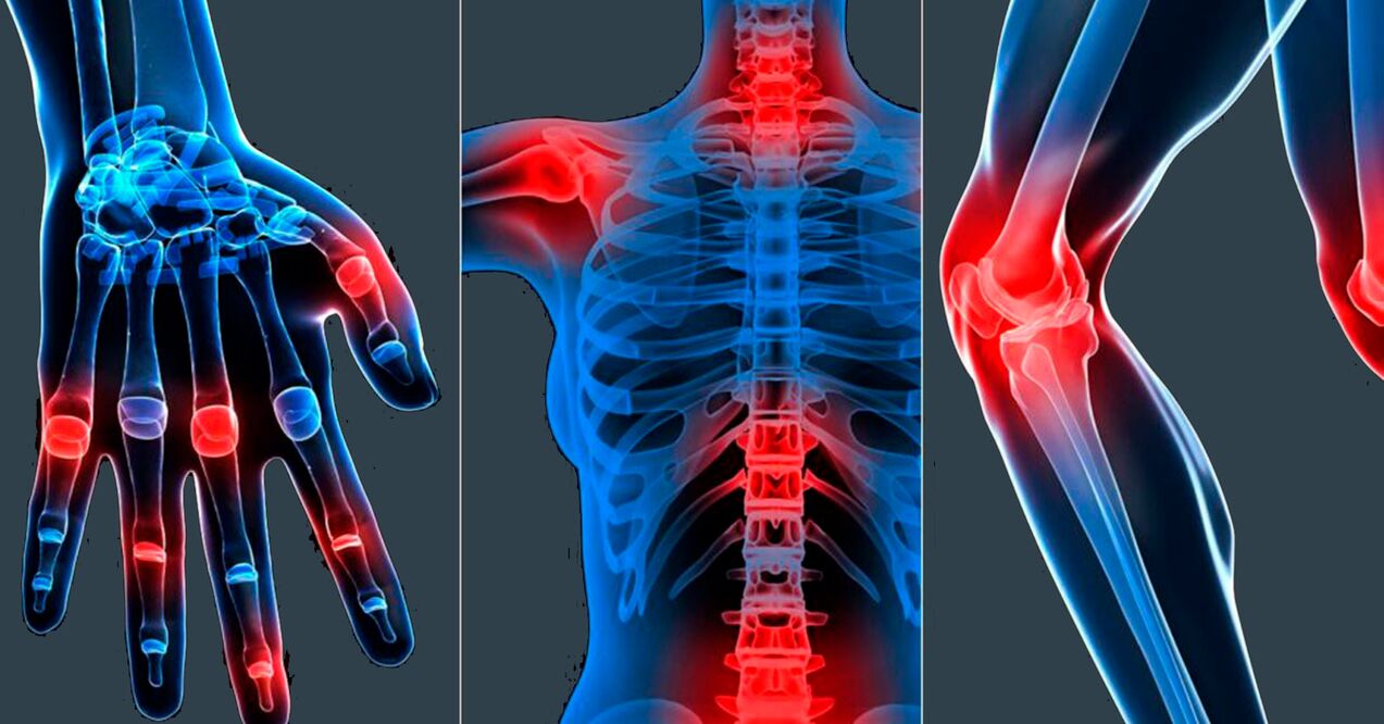 Indikācijas Boswellia ekstrakta lietošanai kapsulās