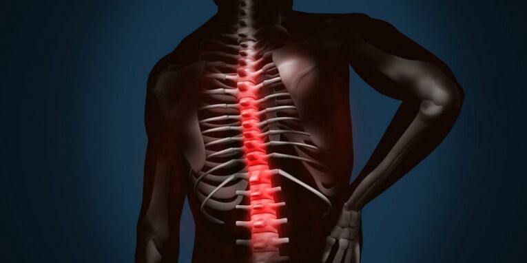 mugurkaula bojājumi osteohondrozes dēļ